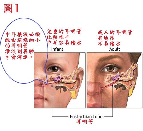 中耳炎 中耳積水必須靠中西醫結合 由外引流 由內托膿 恩加 中西醫 診所