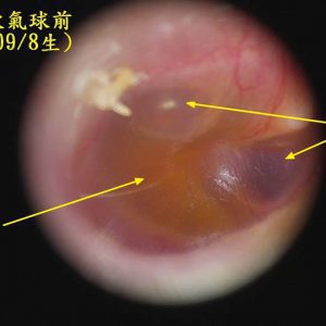 鼻孔吹氣球可以避免中耳積水不必要的開刀 鼻孔吹氣球可以避免中耳積水不必要的開刀