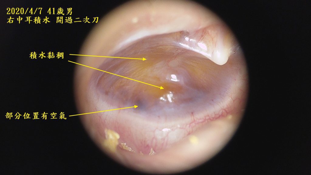 另一個中耳積水受害者 恩加 中西醫 診所