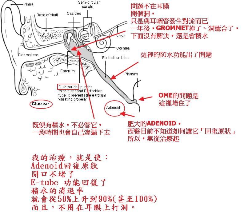 中西醫結合是如何而治好中耳積水的 中耳積水 中西醫結合治療中耳積水