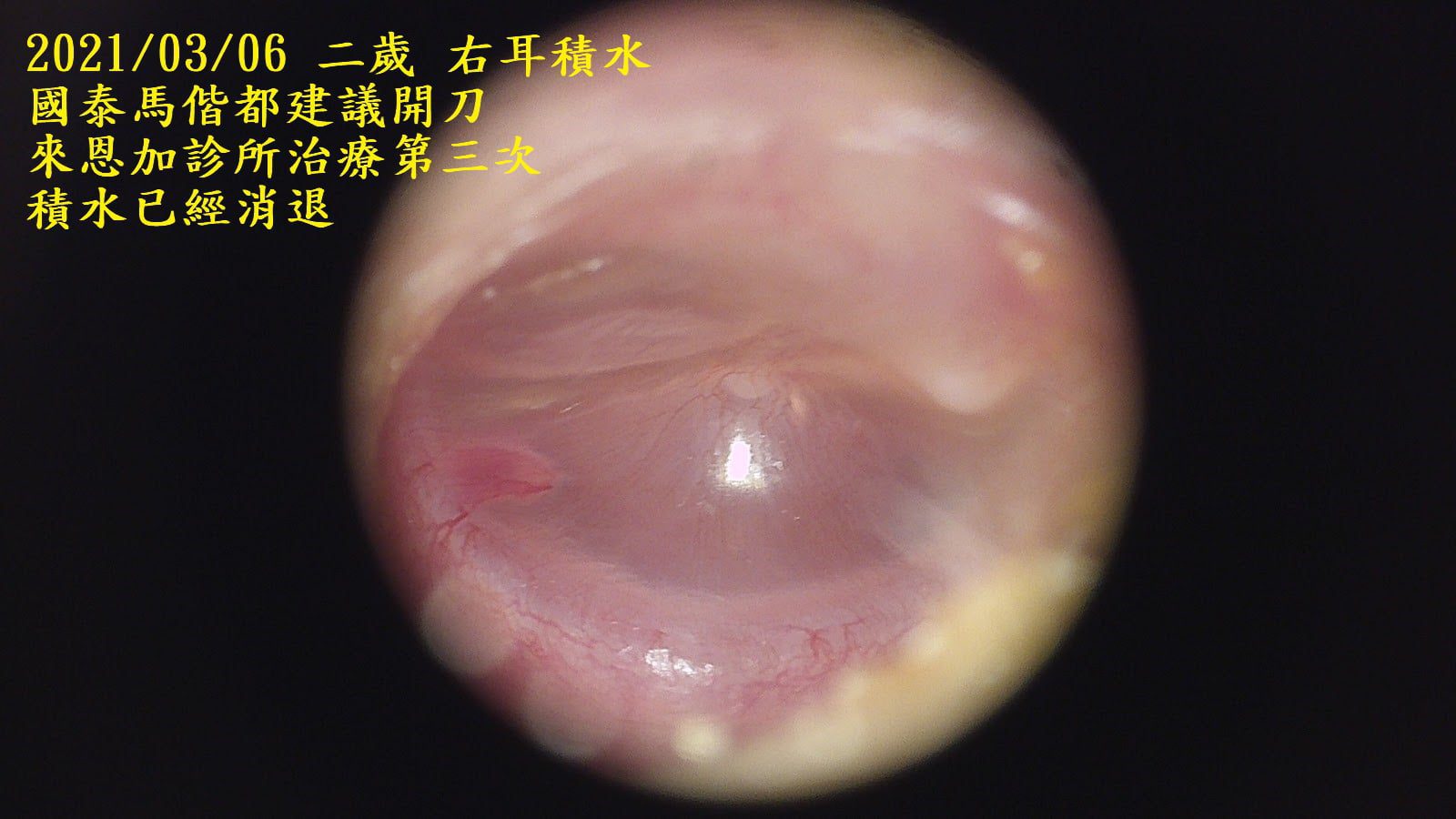 兒童中耳積水,玩具喇叭嘛也通! 中耳積水 治療三次後積水已退