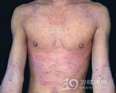異位性皮膚炎 中耳積水 青蒿診所|中西醫整合治療