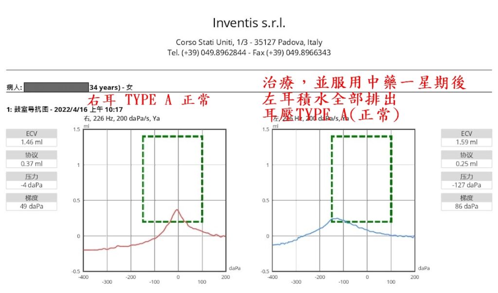 中耳積水中耳炎,穿刺耳膜是無效的 中耳積水 青蒿診所|中西醫整合治療