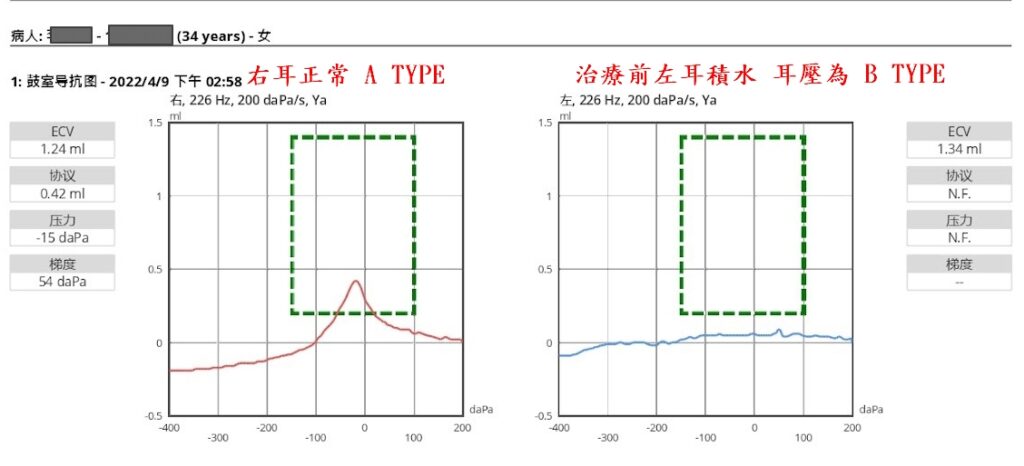 中耳積水,穿刺耳膜抽水是無效的 中耳積水 青蒿診所|中西醫整合治療