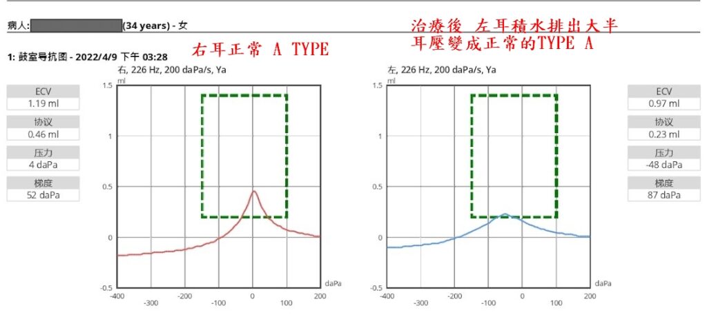 中耳積水,穿刺耳膜抽水是無效的 中耳積水 青蒿診所|中西醫整合治療