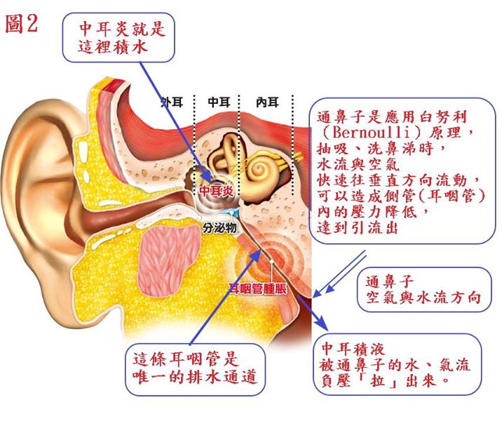中耳積水有更正確有效的方法,不要再傻傻拿耳膜開刀了 中耳積水 中耳積水解說