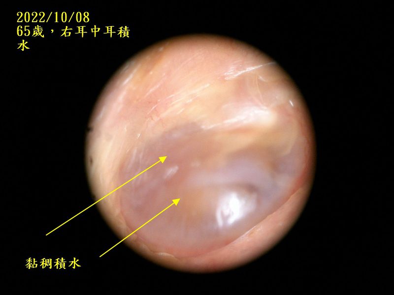 耳鼻喉科醫學會庸醫,中耳積水的患者務必張大眼睛 中耳積水 20221008右耳中耳積水