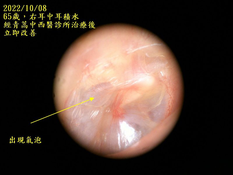 耳鼻喉科醫學會庸醫,中耳積水的患者務必張大眼睛 中耳積水 20221008治療後右耳