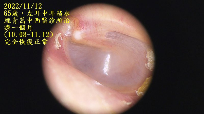 耳鼻喉科醫學會庸醫,中耳積水的患者務必張大眼睛 中耳積水 耳鼻喉科醫學會庸醫