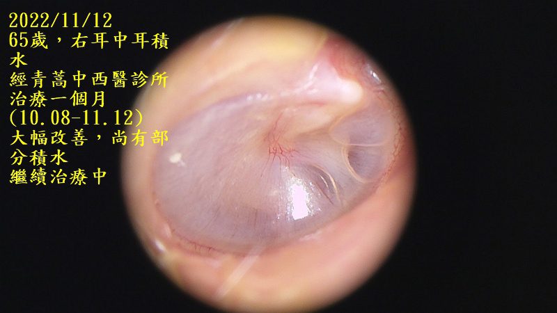耳鼻喉科醫學會庸醫,中耳積水的患者務必張大眼睛 中耳積水 20221112右耳積水已改善