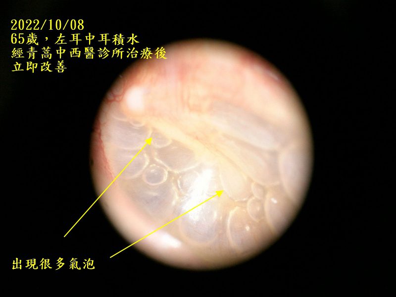 耳鼻喉科醫學會庸醫,中耳積水的患者務必張大眼睛 中耳積水 20221008左耳中耳積水