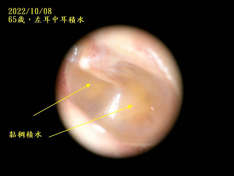 耳鼻喉科醫學會庸醫,中耳積水的患者務必張大眼睛 中耳積水 20221008左耳中耳積水
