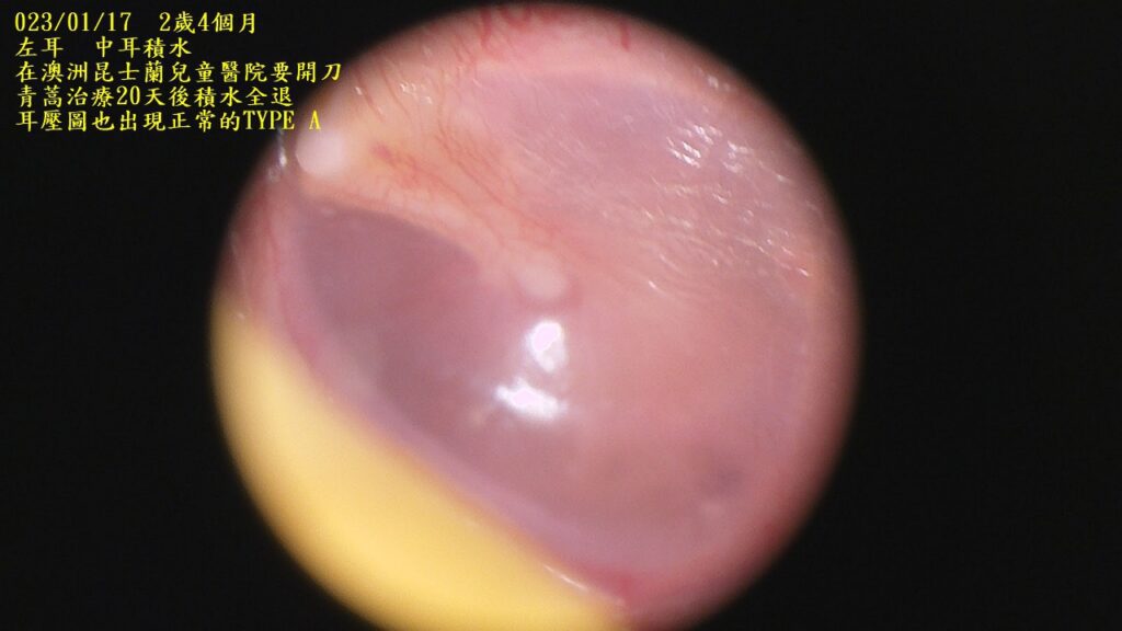 兒童中耳積水已全退