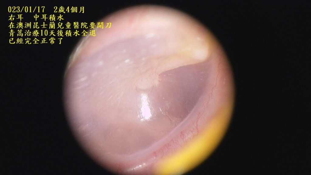右耳-中耳積水已完全正常