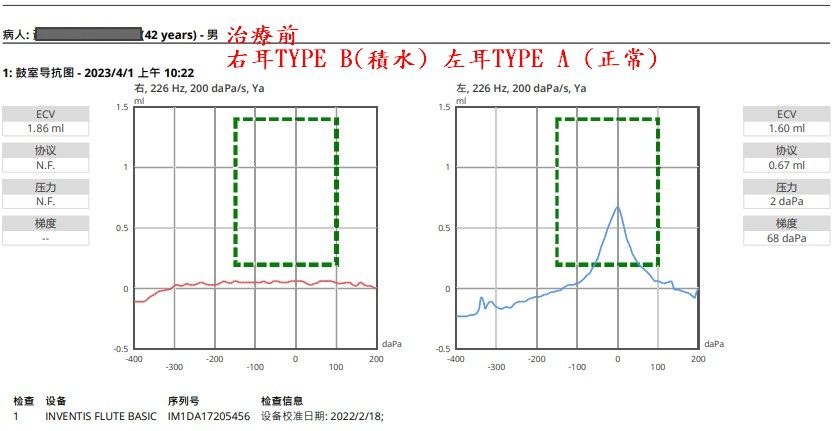 治療前耳壓