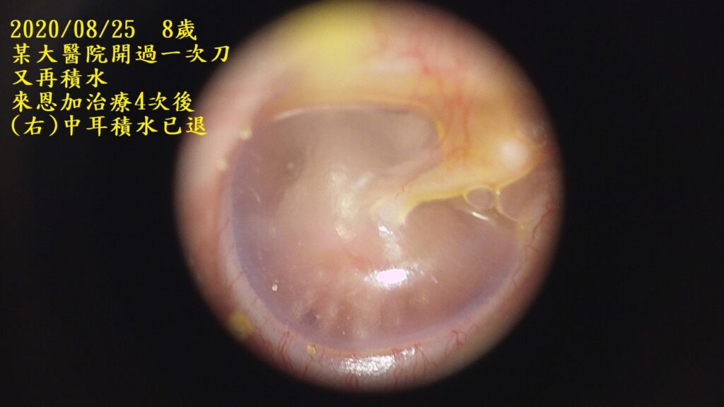 兒童中耳積水開刀?!你知道不用開刀吃西藥,就可以痊癒嗎? 中耳積水 兒童中耳積水開刀