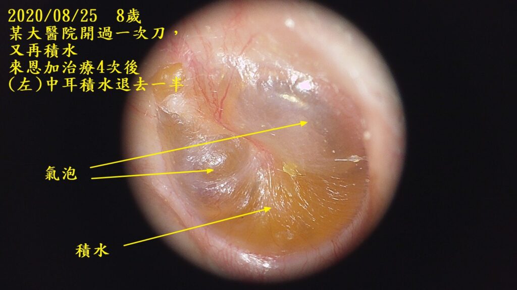 兒童中耳積水開刀?!你知道不用開刀吃西藥,就可以痊癒嗎? 中耳積水 兒童中耳積水開刀