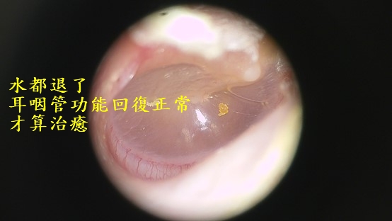 中耳積水問題不在中耳,是耳咽管功能出問題 中耳積水 中耳積水治療