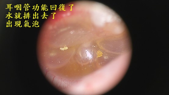 中耳積水問題不在中耳,是耳咽管功能出問題 中耳積水 中耳積水治療
