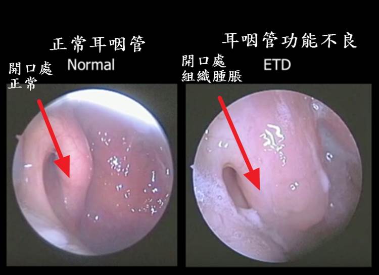 中耳積水問題不在中耳,是耳咽管功能出問題 中耳積水 中耳積水治療