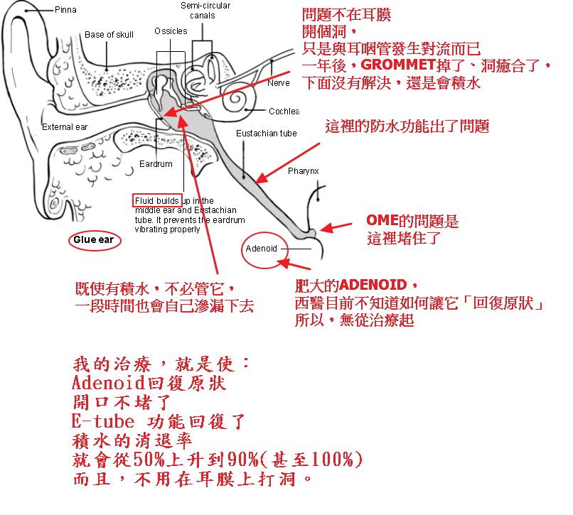 中耳積水問題不在中耳,是耳咽管功能出問題 中耳積水 中耳積水治療