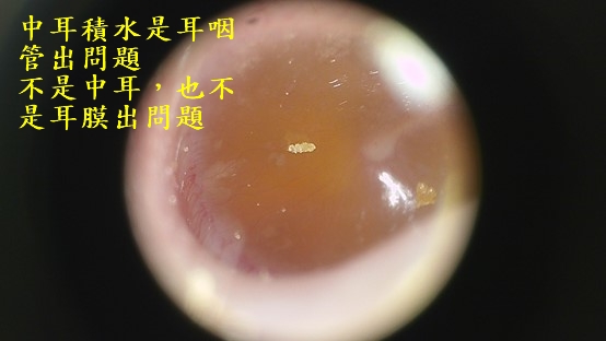 中耳積水問題不在中耳,是耳咽管功能出問題 中耳積水 中耳積水治療