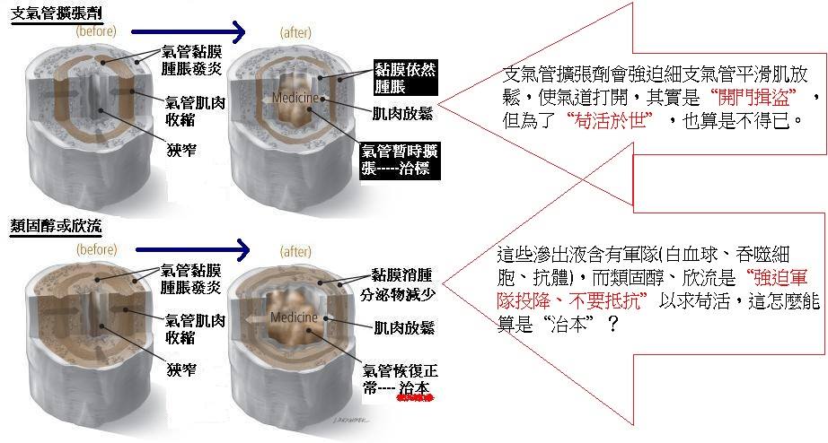 氣喘|遠離類固醇 中耳積水 青蒿診所|中西醫整合治療