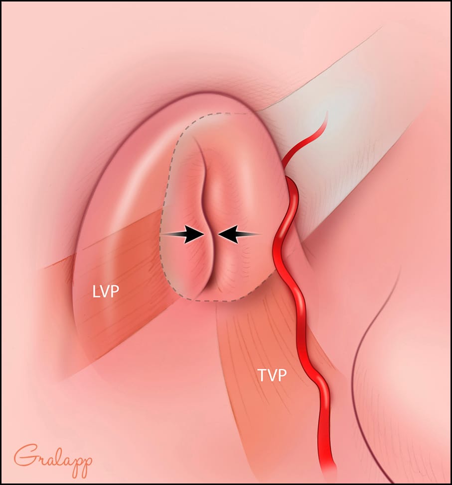耳咽管位置示意圖 3