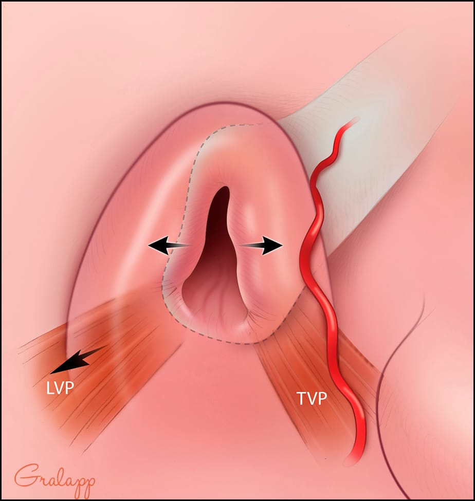 耳咽管位置示意圖 4